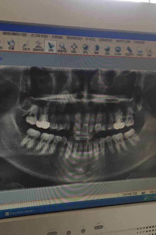 치과의사도 포기한 내 치아 .jpg