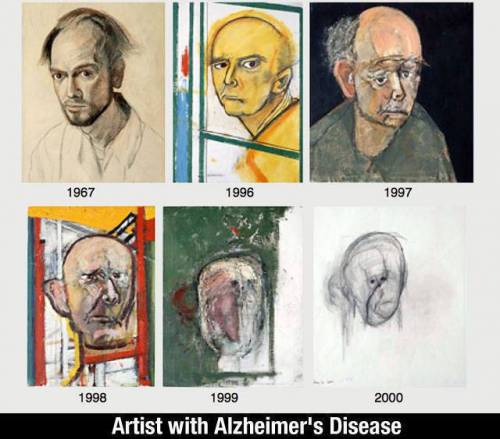 알츠하이머 치매환자가 그린 그림의 변화