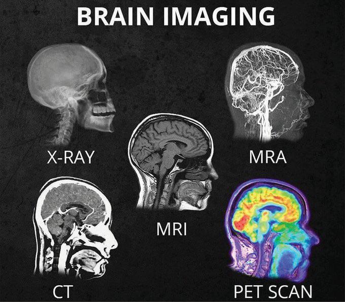 다양한 유형의 뇌 이미지