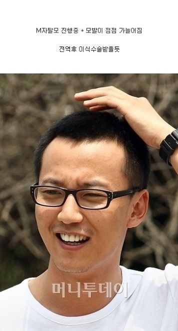 연예인 탈모.jpg