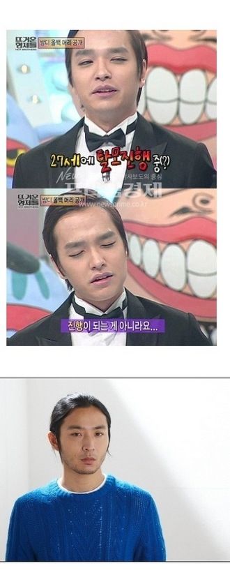 연예인 탈모.jpg