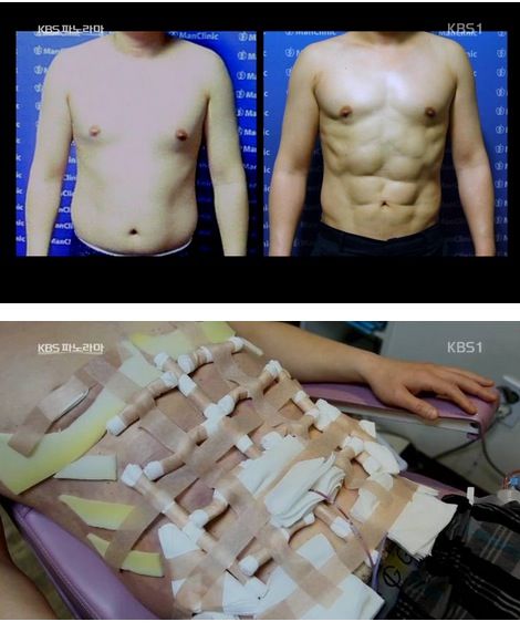 복근도 성형하는 세상.jpg