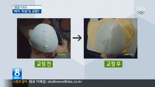 흔한 교정기.jpg