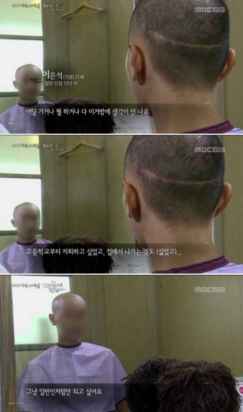 탈모 환자가 받는 스트레스