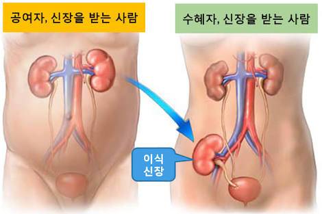 신장이식 많이들 하는 오해.jpg