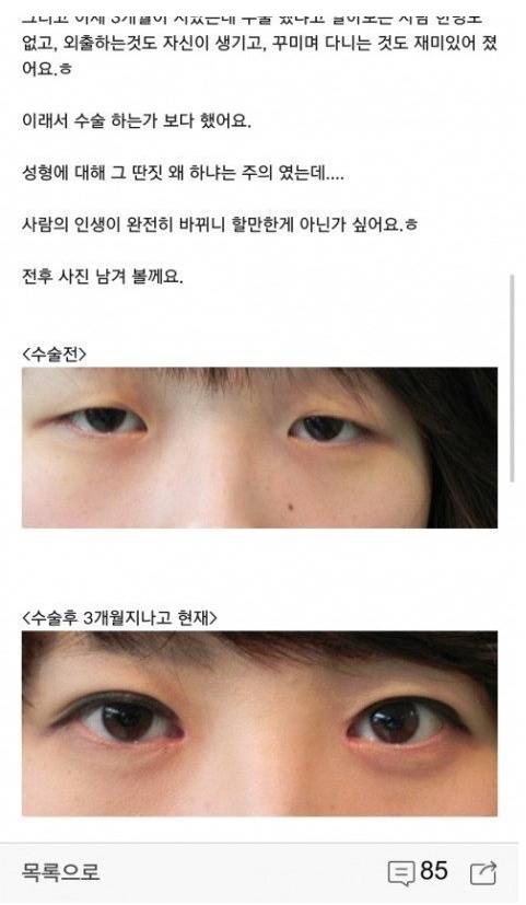 남자 눈매 성형 전 후.jpg