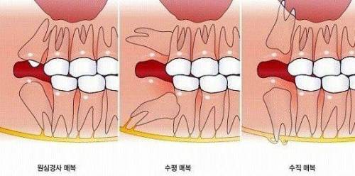 사랑니.jpg