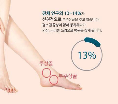 10명중 1명이 있다는 발의 뼈.jpg