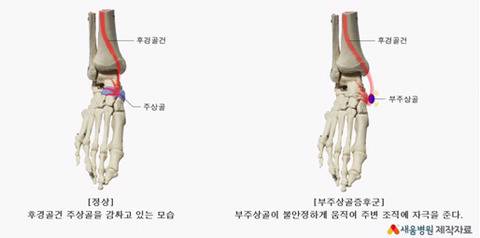 10명중 1명이 있다는 발의 뼈.jpg