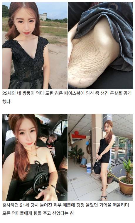 네 쌍둥이 임신 중 생긴 튼살을 공개한 23세 엄마.jpg