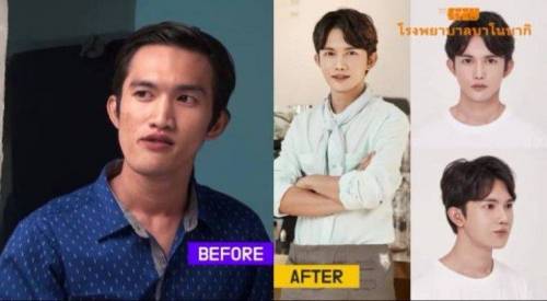 한국에서 성형한 태국남자 jpg