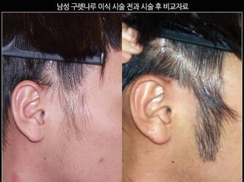 구렛나루 이식 수술.jpg