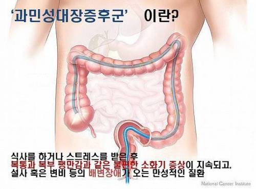 과민성 대장증후군.jpg