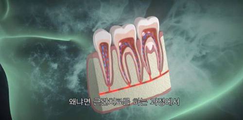 [스압] 신경치료의 진실(?).jpg