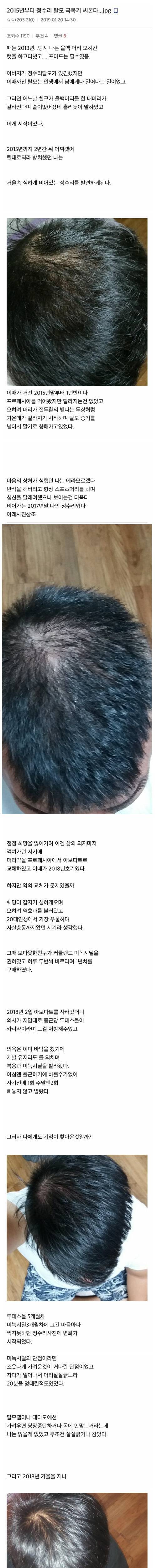 [스압] 정수리 탈모 극복기.jpg
