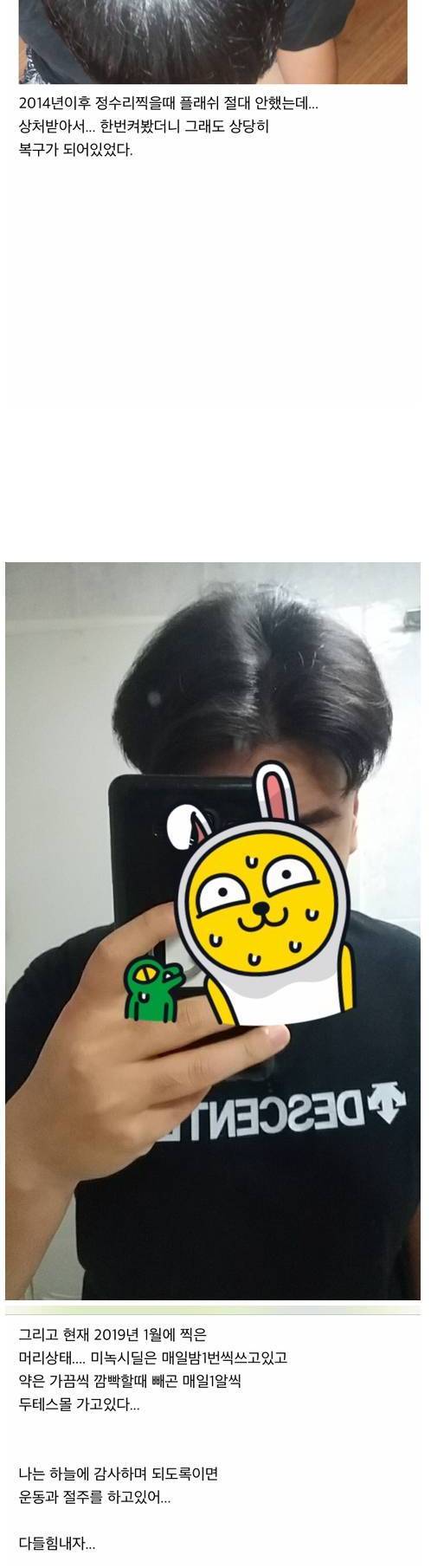 [스압] 정수리 탈모 극복기.jpg