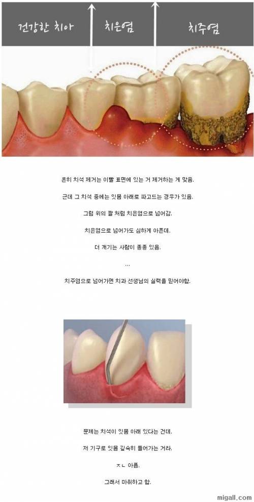 치석을 제거해야 하는 이유.jpg