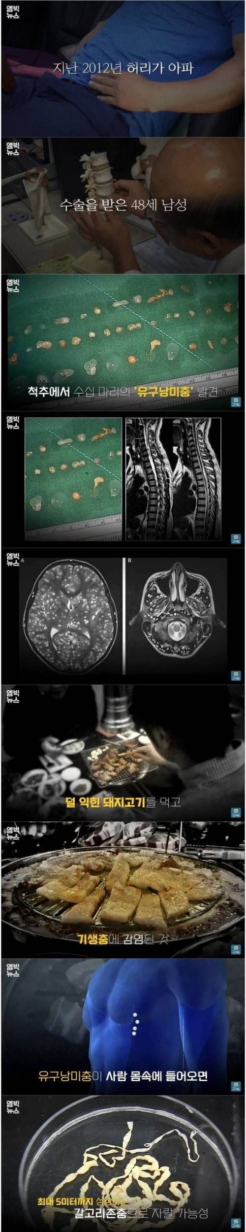 [스압] 삼겹살 먹다 감염된 기생충이 뇌와 척추까지 퍼진 이유
