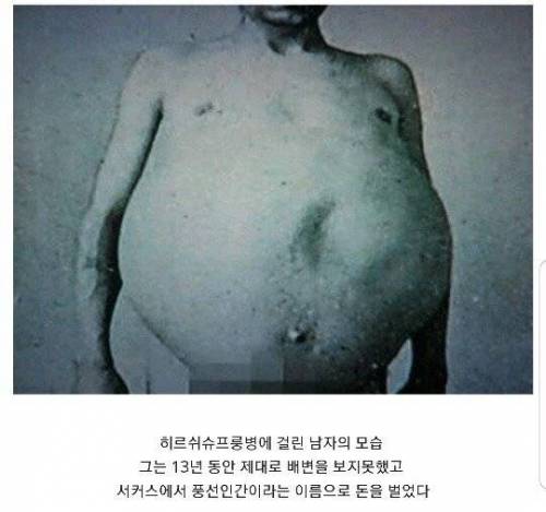 [약더]13년간 똥을 싸지 못한 남자.jpg