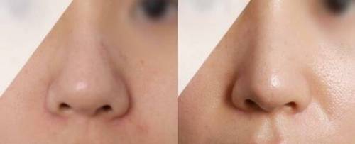 요즘 인기라는 성형수술.jpg