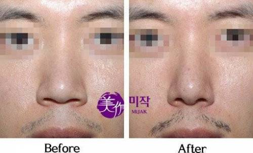 요즘 인기라는 성형수술.jpg