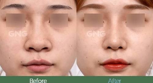 요즘 인기라는 성형수술.jpg