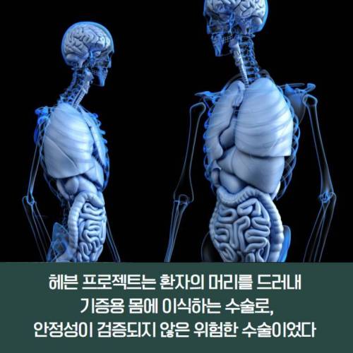 [스압] 살기 위해 머리 이식 수술을 선택했던 사람.jpg