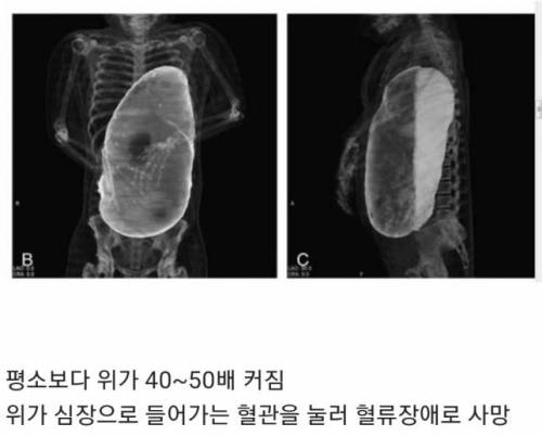 20인분 이상 먹고 사망한 사람의 엑스레이.jpg