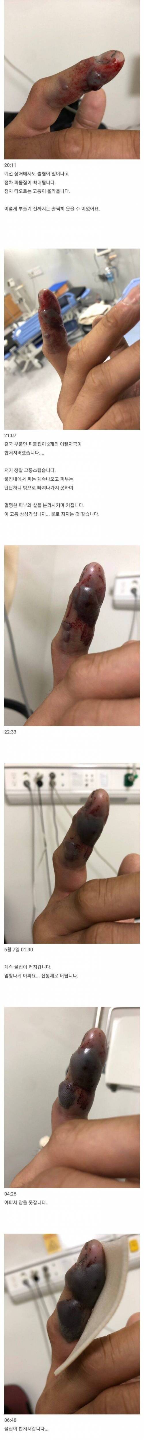 [스압] [극혐] 쇠살모사 한테 손가락 물린 후기.jpg