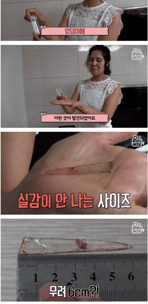 [스압] 36년 전 엉덩이에 박힌 유리조각.jpg