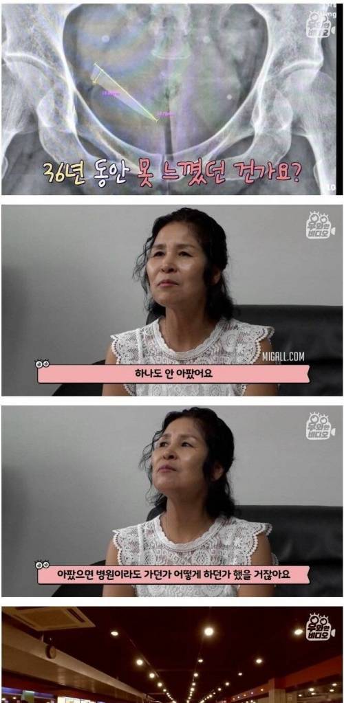 [스압] 36년 전 엉덩이에 박힌 유리조각.jpg