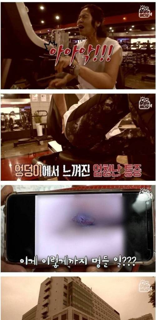 [스압] 36년 전 엉덩이에 박힌 유리조각.jpg
