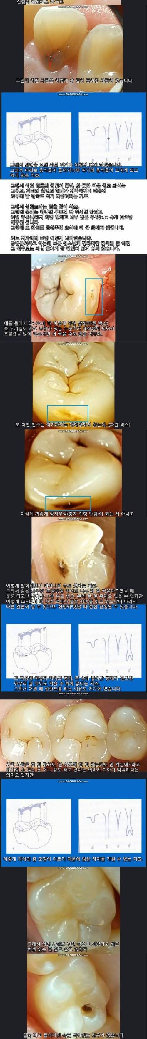 [스압] 치아는 타고나는 것이다.jpg