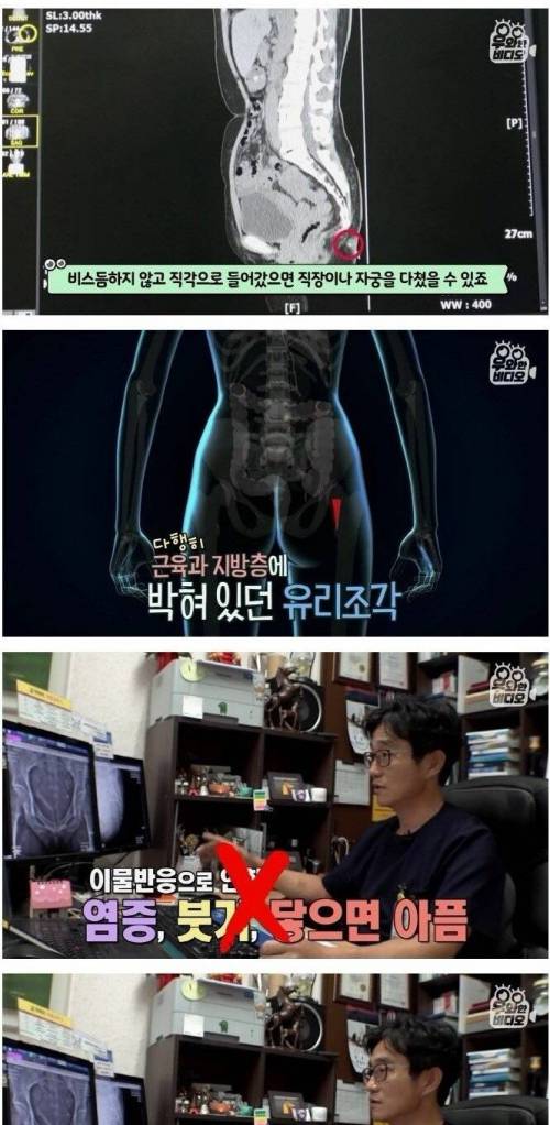 [스압] 36년 전 엉덩이에 박힌 유리조각.jpg