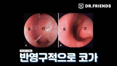 [스압] 약국에서 파는 비염 스프레이 사용 시 주의할 점