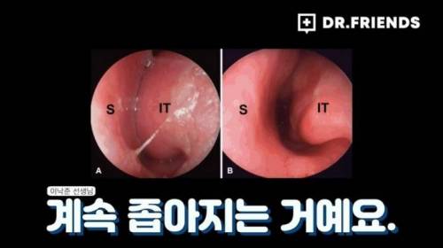 [스압] 약국에서 파는 비염 스프레이 사용 시 주의할 점