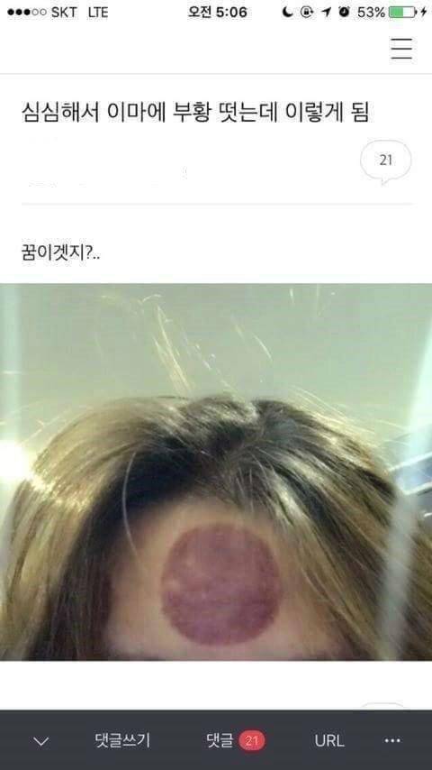 심심해서 부황뜬 여자.jpg