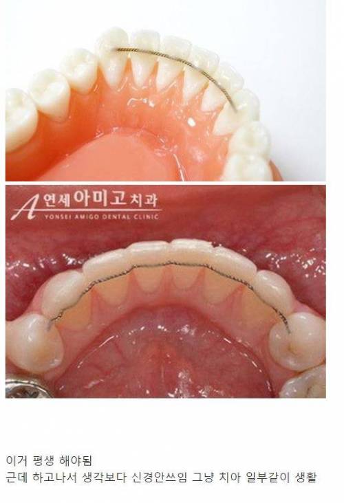 은근 치아교정 전에 이거 모르고 하는 사람 많음.jpg