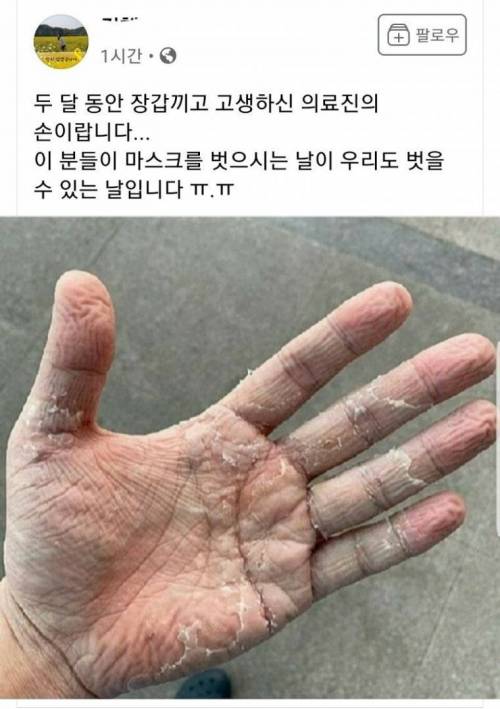 두 달 동안 장갑끼고 고생한 의료진의 손....jpg