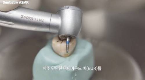 [스압] 충치 치료과정.jpgif
