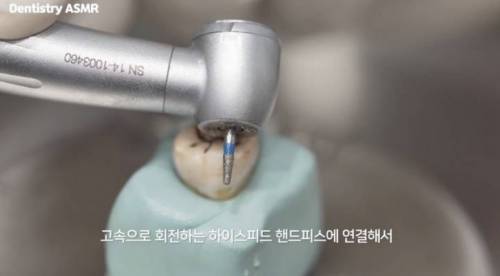 [스압] 충치 치료과정.jpgif