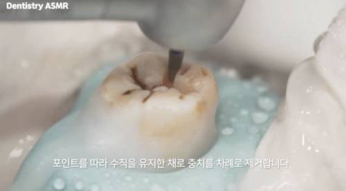 [스압] 충치 치료과정.jpgif