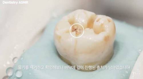 [스압] 충치 치료과정.jpgif