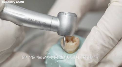 [스압] 충치 치료과정.jpgif