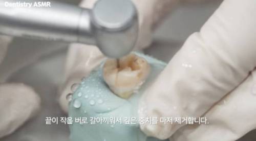 [스압] 충치 치료과정.jpgif