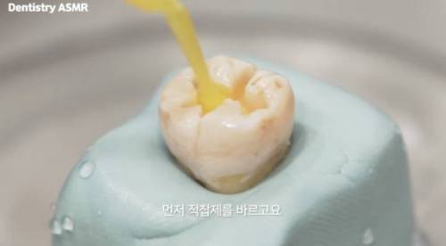 [스압] 충치 치료과정.jpgif