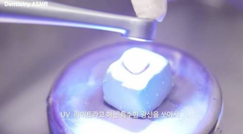 [스압] 충치 치료과정.jpgif