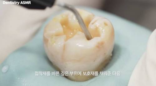 [스압] 충치 치료과정.jpgif