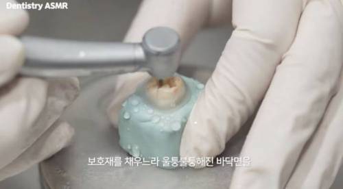 [스압] 충치 치료과정.jpgif