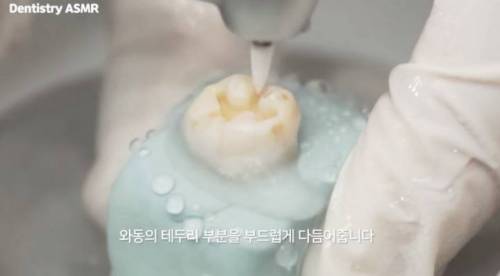 [스압] 충치 치료과정.jpgif
